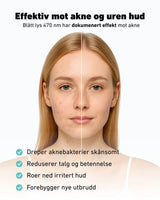 Før-og-etter bilde av ung kvinne med akne, hvor venstre side av ansiktet viser uren hud med kviser og rødhet, og høyre side viser jevn, ren hud. Øverst står teksten ‘Effektiv mot akne og uren hud – Blått lys 470 nm har dokumentert effekt mot akne’. Nederst listes fordelene: dreper aknebakterier skånsomt, reduserer talg og betennelse, roer ned irritert hud og forebygger nye utbrudd.