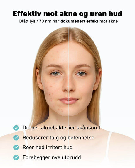 Før-og-etter bilde av ung kvinne med akne, hvor venstre side av ansiktet viser uren hud med kviser og rødhet, og høyre side viser jevn, ren hud. Øverst står teksten ‘Effektiv mot akne og uren hud – Blått lys 470 nm har dokumentert effekt mot akne’. Nederst listes fordelene: dreper aknebakterier skånsomt, reduserer talg og betennelse, roer ned irritert hud og forebygger nye utbrudd.